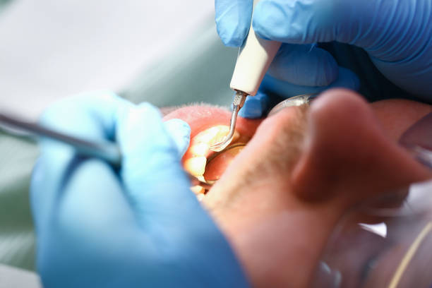 Best Emergency Tooth Extraction in Cooper, TX